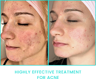 Peppermint Peel highly effective Acne treatment results